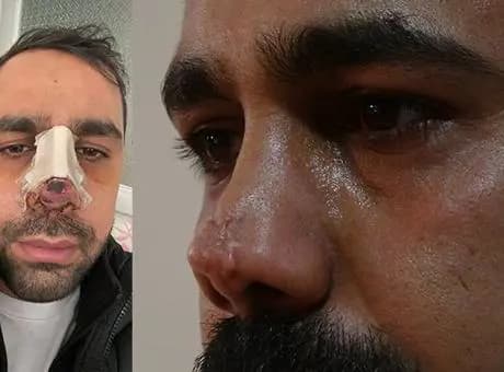 Burun ameliyatı sonrası hayatı kabusa döndü! 40 bin avroluk tedavi çıktı