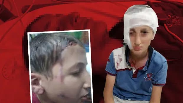 Hayat karartan ısırık için mahkemeden 1.2 milyon lira tazminat kararı: Yaşadığı kabustan sonra çocuğun yüzünde kalıcı izler meydana geldi