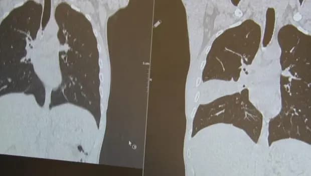 Kanser sanılan lezyon kemik çıktı! 'Kemiği seven biriyim, şaşırtmadı'